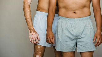 cellulite ook bij mannen
